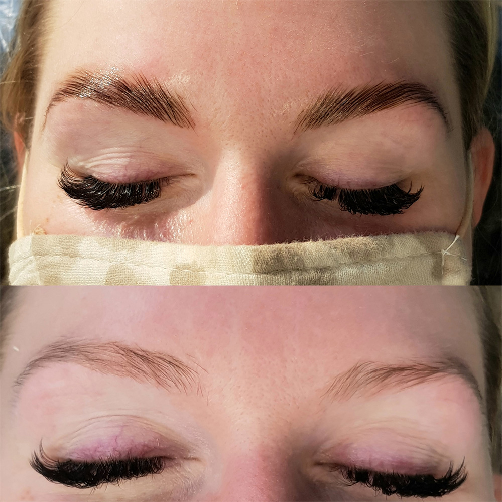 Brow lift Washington, DC